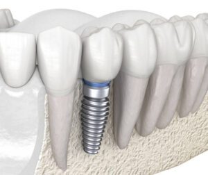 Dental Implants
